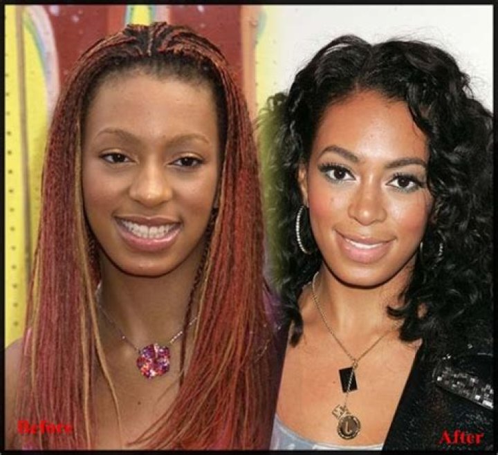 Ciara Nose Job Plastic Surgery Before and After