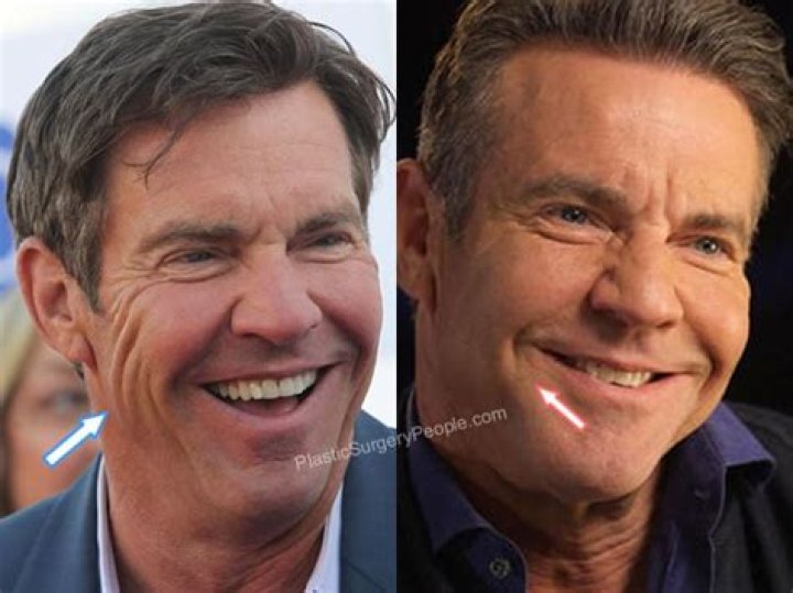Dennis Quaid Plastic Surgery: Dennis's Choice to Avoid Signs of Aging!