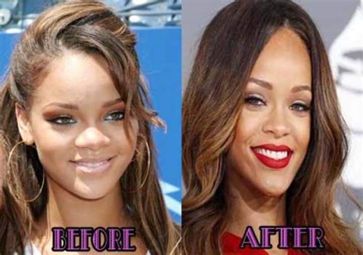 Rihanna Nose Job Plastic Surgery Before and After
